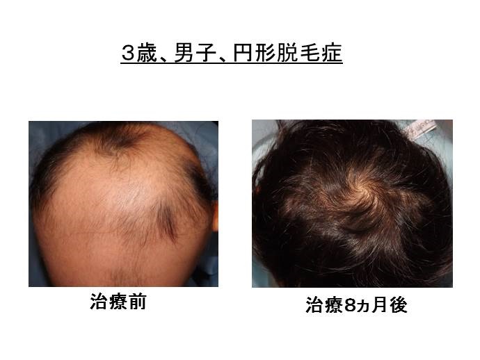 円形脱毛症　病院""